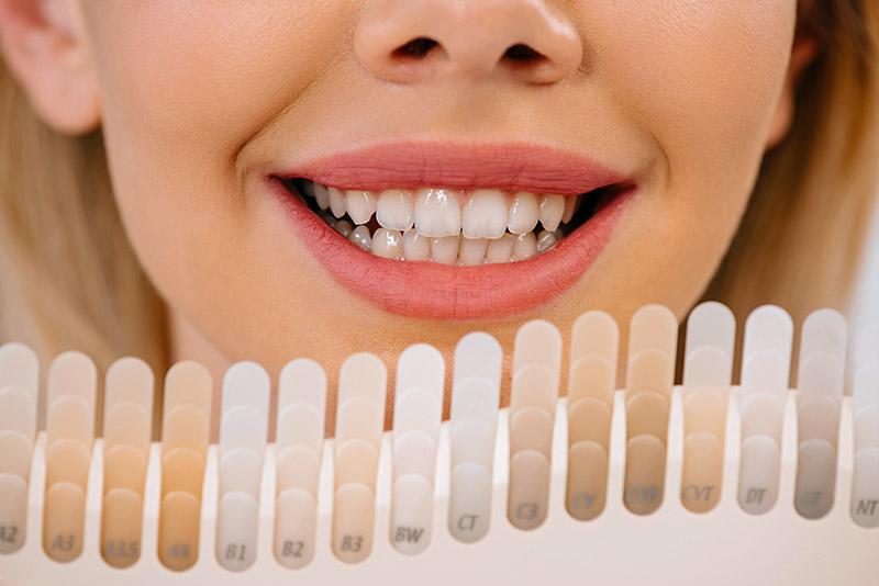 Dental Veneers in London